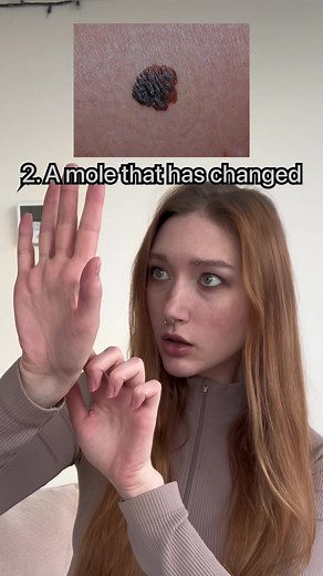 Importance of Regularly Checking Your Moles for Skin Cancer Prevention