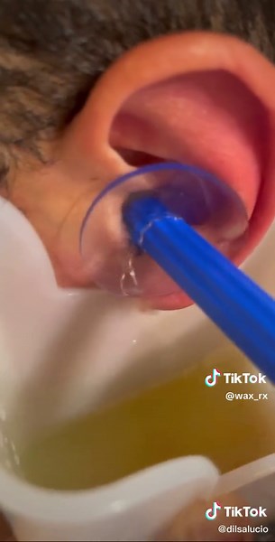 @dilsalucio showing off the Wax-Rx at work 💪 Thanks for sharing your experience 😁 Get yourself a kit at the link in our bio to start seeing great results like this! #earwaxremoval #oddlysatisfying #earwax #waxrx