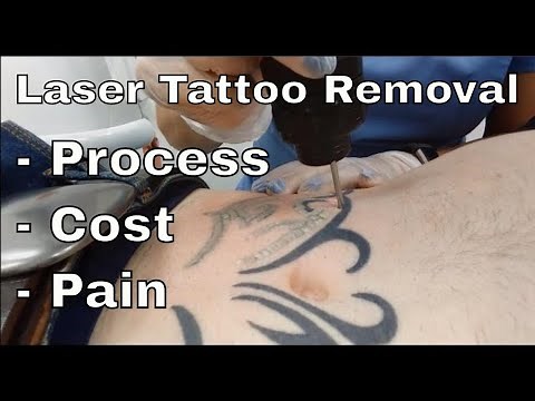 My First Session of Laser Tattoo Removal