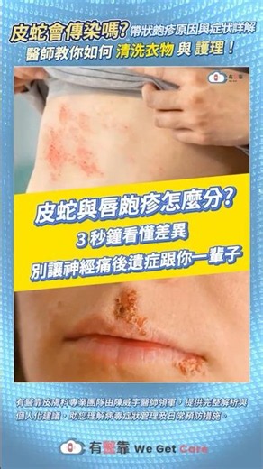 皮蛇與唇皰疹怎麼分？ 3 秒鐘看懂差異，別讓神經痛後遺症跟你一輩子