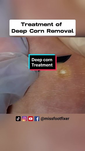 Effective Foot Corn Treatment Methods