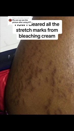 Effective Ways to Remove Stretch Marks Naturally