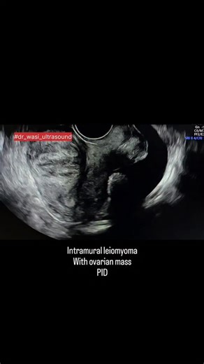 Uterine fibroid #fibroiduterus #fibroids #fibroid #ovariancyst #ovarianmass #dermoidcyst #pid #pelvicinflammatorydisease #gynaecology #uterus #dr_wasi_ultrasound #ultrasonography #radiologist #neetpg #medicaleducation #abdominalultrasound #radiologie #pelvicultrasound | Ultrasound made easy