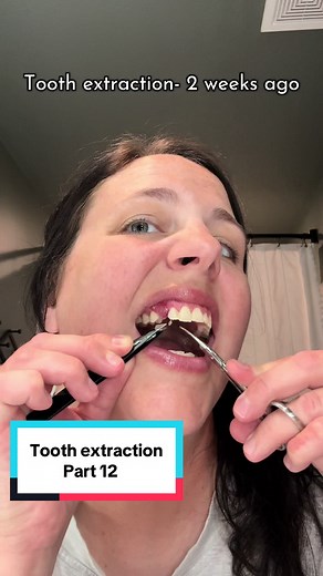 Tooth Extraction Journey: Trimming Sutures After 2 Weeks