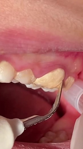 Effective Tartar and Calculus Removal Techniques