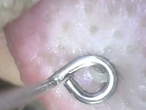 2023 Pops - pimples & sebaceous filaments filmed in 2023, just posting now - Sept. 5, 2025 video