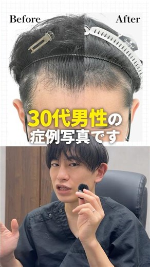 [Case study] Regenerative treatment improves hairline and crown!!