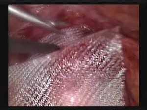 Laparoscopic Sacral Colpopexy - Urogynaecology