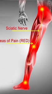 sciatica nerve sign and symptoms in Pashto by Mustaqeem Health Care awareness videos #sciatica #nerve #sign #symptoms #pashto #mustaqeemhealthcare #mustaqeemhealthcarevideos #medicalinformation | Dr. Mustaqeem