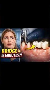 Missing Tooth? Dental Bridge Procedure Step-By -Step: ✅🦷(Fast and Best)