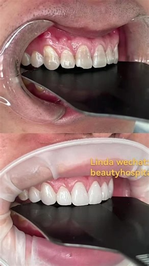 Veneer Beauty: Effective Teeth Whitening Solutions