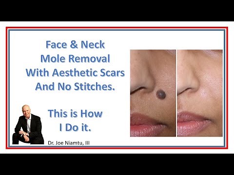 Face & Neck Mole Removal with Aesthetic Scars: No Cutting, no Stitches