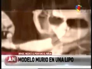 modelo brasilera muere tras una liposucción