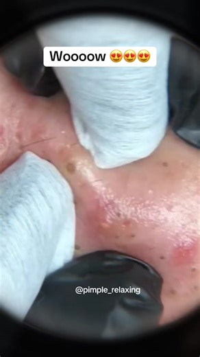 Satisfying Blackhead Removal Video