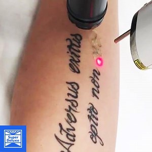 8.4M views · 4.5K reactions | Here's what laser tattoo removal looks like. | Tatered | Facebook