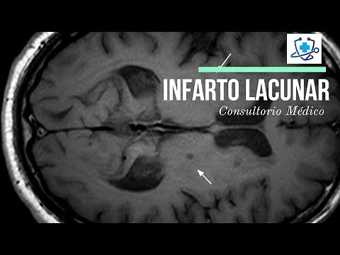 Infarto Lacunar: Causas, Síntomas y Tratamiento 👨‍⚕️ Consultorio Médico