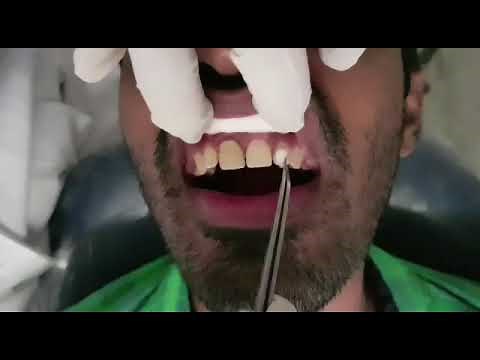 Thermal and Electric Pulp Testing