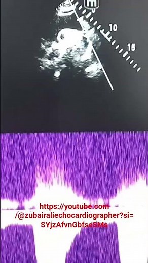 coarctation of aorta proximal to the left subclavian artery.