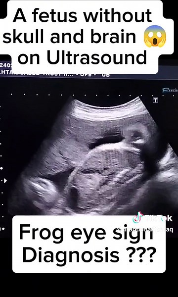 Understanding Anencephaly: Diagnosis and Genetic Defects Explained