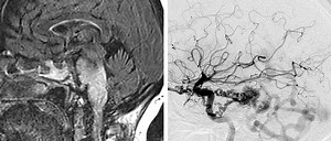 Infratentorial Dural Arteriovenous Fistulas | Cohen Collection | Volumes | The Neurosurgical Atlas
