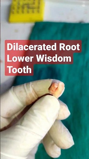 🇳🇵Dilacerated Root! Lower Wisdom Tooth! Surgical Extraction! Dental Clinic in Kathmandu! Curved Root
