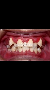 Braces progress in 14months #satisfying #braces #bracesprogress | Braces Shop Online
