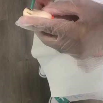 Biopsy of Subungual Melanoma