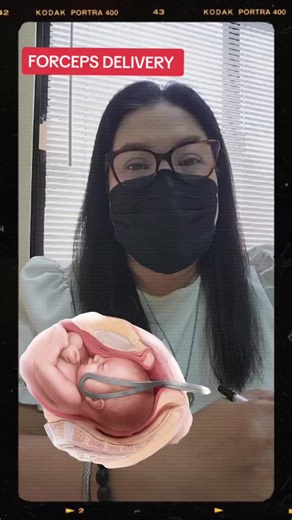 Understanding Forceps Delivery: Risks, Prerequisites, and Procedure