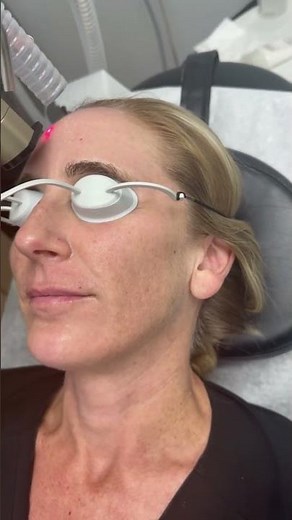 Alma Hybrid CO2 Laser Treatment: Is it Painful? | South Bay Med Spa