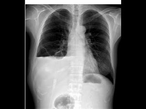Chest X-ray air-fluid levels vs anatomy