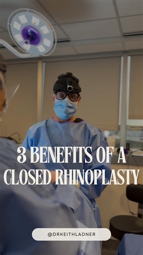 Keith Ladner MD PA on Instagram: "Hey guys! Dr. Ladner here — reporting from the operating room today for your education question: What are the benefits of a closed rhinoplasty?? 1 - all incisions are internal (invisible scars) 2 - we don’t change any good parts of the nose 3 - the process of skin shrinking to match the smaller size of the nose occurs more rapidly Comments or questions? Let us know! We would love to hear your feedback on your own concerns if we didn’t list them in the video abov