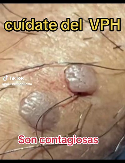 VPH: Conoce las Verrugas, Síntomas y Prevención