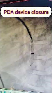 PDA device closure#PDA device closure procedure#PDA device