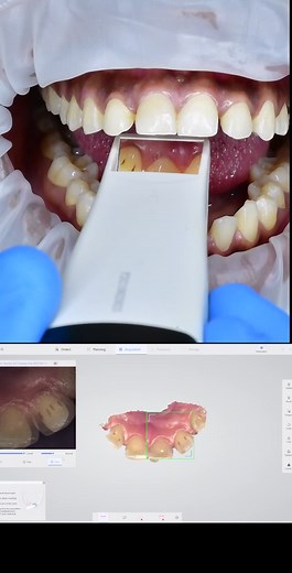 Intraoral Scanner: Taking a Mess-Free Mould of Your Teeth