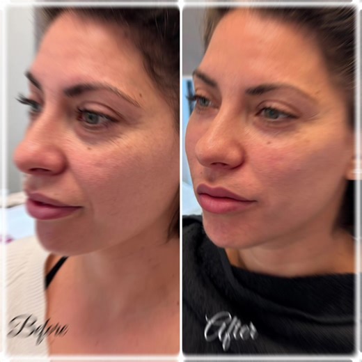 PRF Injections and Microneedling Special Offer Today