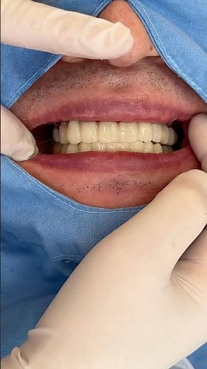 전체임플란트 수술당일 임시치아 #dentist #dental #implants #smile #하루에치과