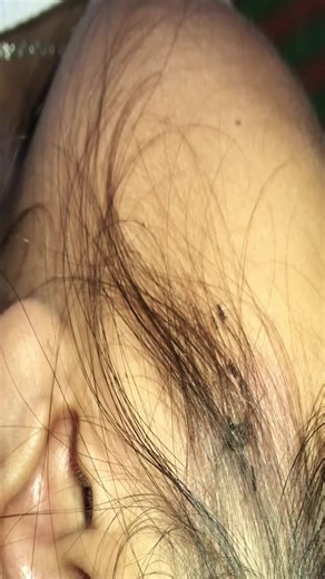 Effective Lice Treatment Techniques for Healthy Hair