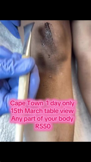 Benefits of Carbon Laser Peels for Glowing Skin