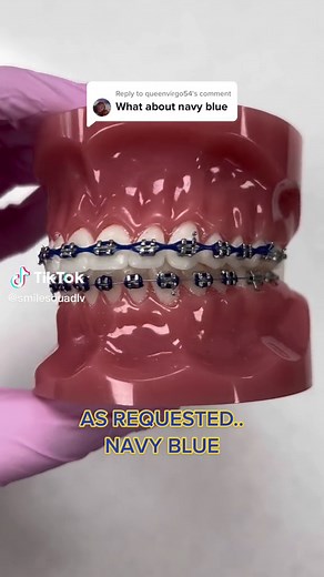 Best Navy Blue Braces Colors for Your Braces Journey