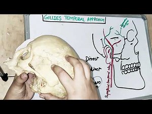 gillies temporal approach I dental lectures