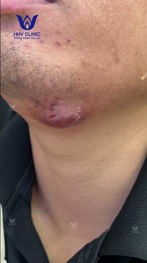 Painful Swollen Abscess on Chin