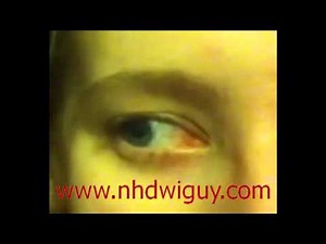 Horizontal Gaze Nystagmus (HGN) - DUI Field Sobriety Eye Test