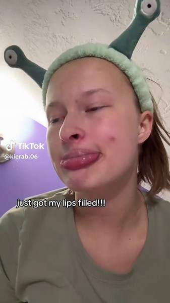 Lip Fillers: My Personal Experience and Results