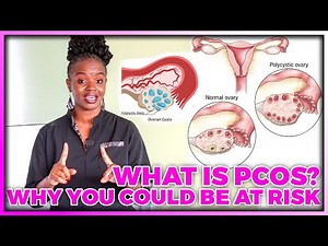 PCOS Guide By A Doctor: Doctor’s PCOS Guide On Causes, Symptoms And Management
