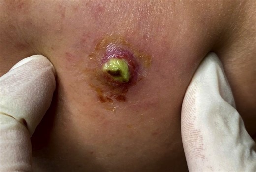 Tiny Cyst Lots of Pus