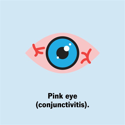 Avian influenza, commonly called “bird flu,” is a viral infection that spreads in birds, cows and other animals. It can sometimes spread to people. In humans, H5 subtypes of influenza A are the most common cause. It can cause mild to severe respiratory symptoms and pink eye. People who work with poultry, waterfowl and dairy cows are most at risk. | Cleveland Clinic
