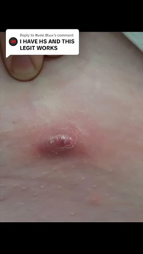 Painful Boils & Cysts vs Universal Skin Healer #skinissues #skinproblems #painfulskin #hs #hidradenitissuppurativa #fyp #abscess #cyst #boils | Mymagichealer