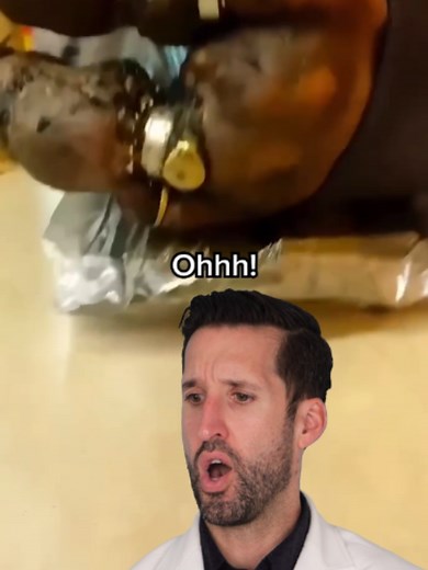 Doctor Reacts to Rings Stuck to Skin | ring stuck on finger