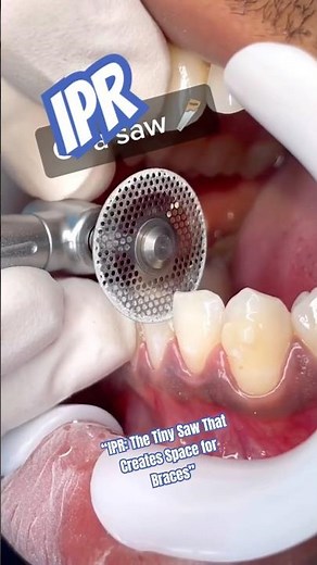 “IPR: The Tiny Saw That Creates Space for Braces”