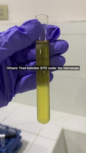 Understanding Mucus Threads in Urinalysis: A Clinical Microscopy Overview